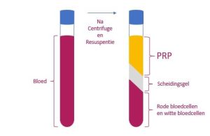 UROLOGIE en PRP